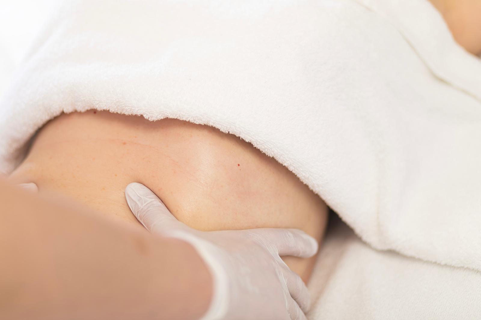 Tratamiento anticelulítico corporal con Procyon FHOS en Esencia Estética Campo Real